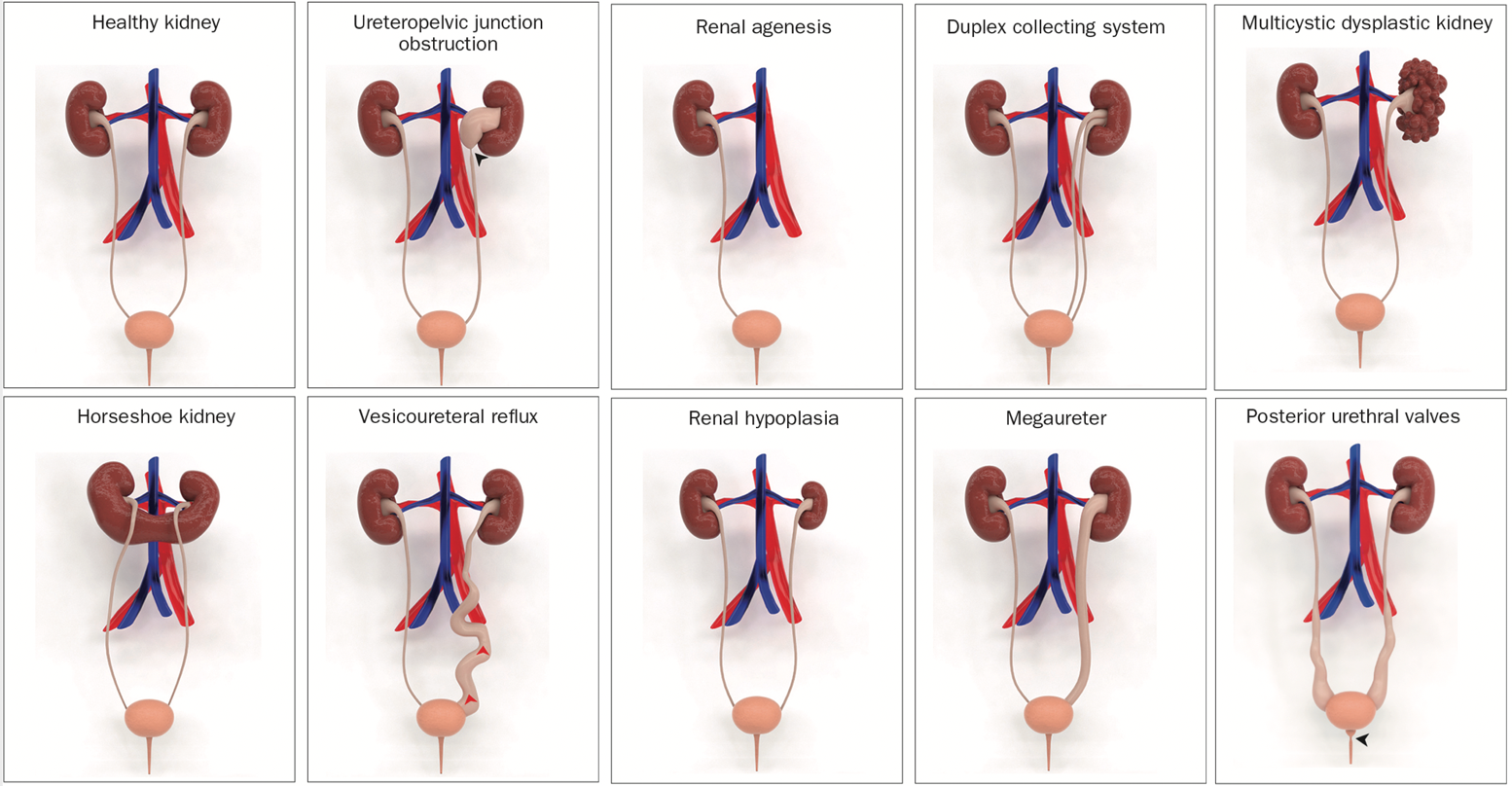Congenital Anomalies Of The Kidney And Urinary Tract Pediatric 