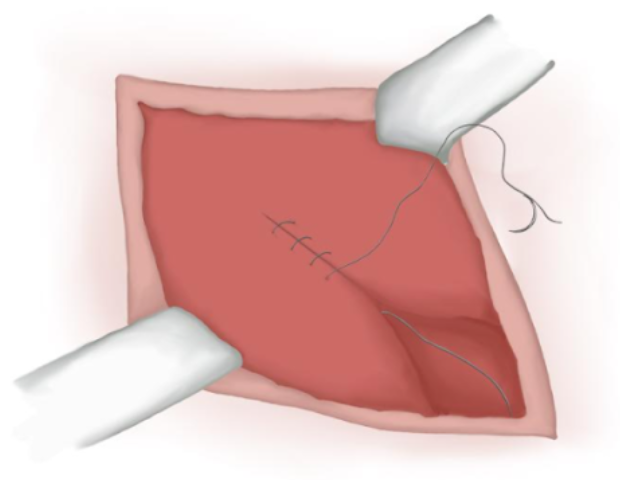 Hydroceles and Inguinal Hernia: Symptoms, Diagnosis & Treatment - Urology  Care Foundation